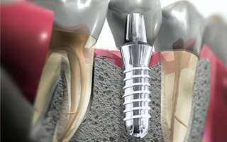 Implantes basales