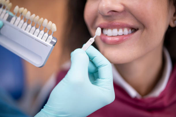 Paciente sonriendo durante selección de tono para carillas dentales en Badajoz